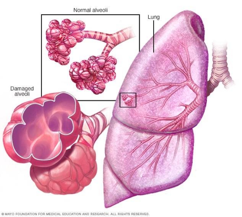 COPD