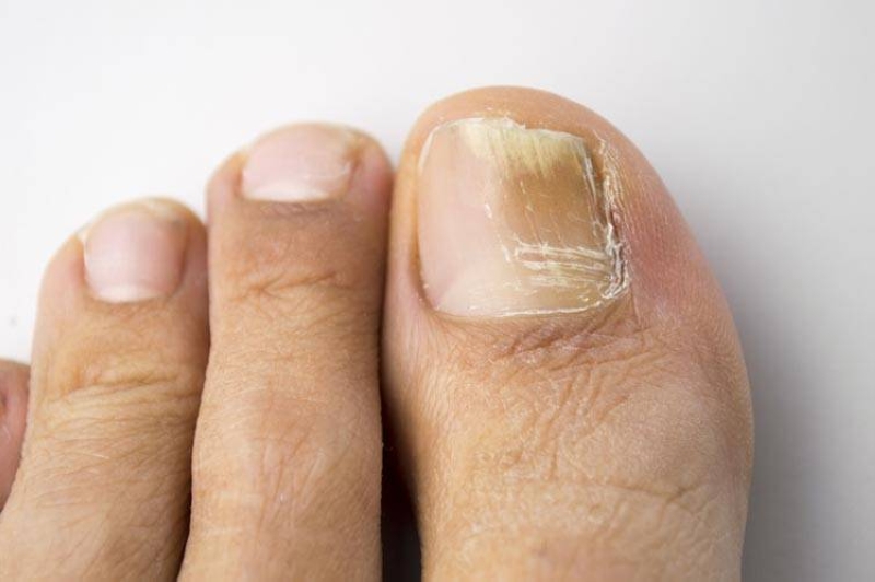 fungal nail infection