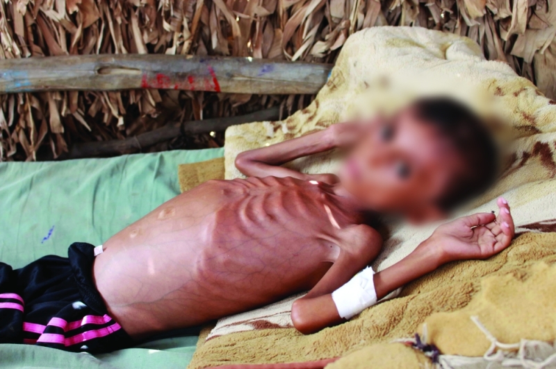Child malnutrition PIC: DHAKATRIBUNE