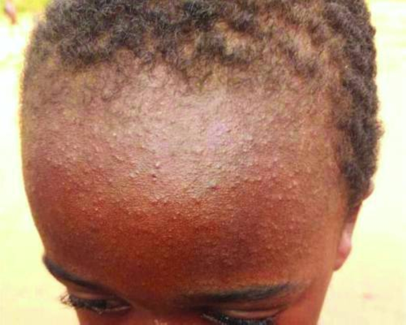 A little boy suffering from Measles. PIC WHO AFRICA