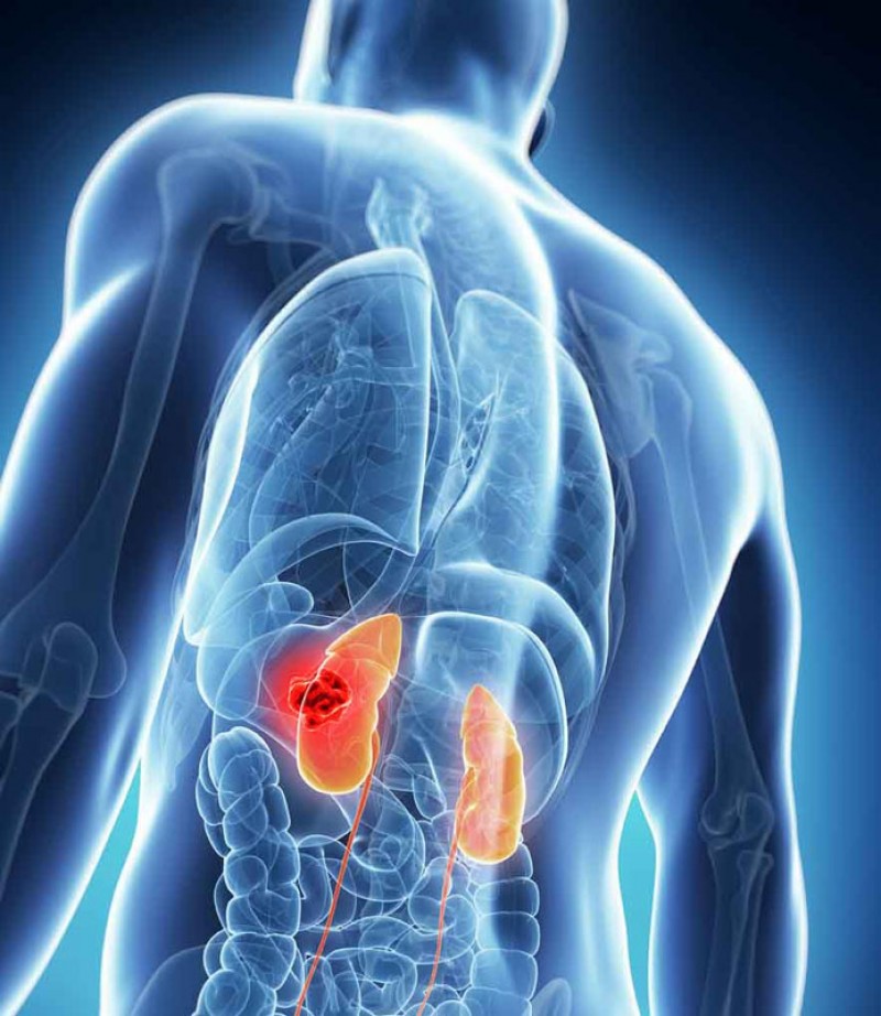 Kidney disease is on the rise in Botswana PIC: WWW.BUAHMERAHMIX.PH